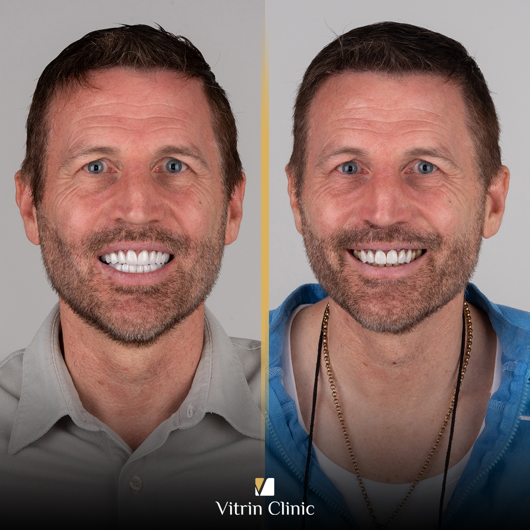 What Is Dental Occlusion? Types, Bite Problems, Assessment, and Treatment